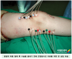 광범위 육종 절제 후 수술을 끝내기 전에 근접방사선 치료를 위한 관 삽입