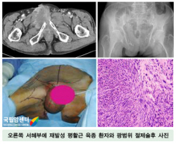 오른쪽 서혜부에 재발성 평활근 육종 환자와 광범위 절제술후 사진