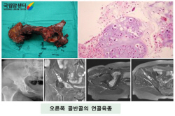 절재해낸 오른쪽 상완골의 골육종