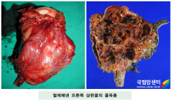 오른쪽 골반골의 연골육종