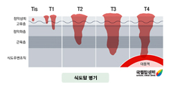 식도암의 병기