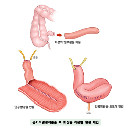 근치적방광적출술 후 회장을 이용한 방광재건