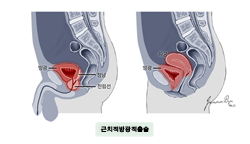 근치적방광적출술
