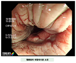 항문암의 대장내시경 소견
