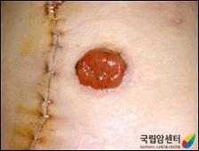 장루주머니 교환 방법(1)