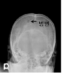 다발성골수종 환자의 두개골 X선