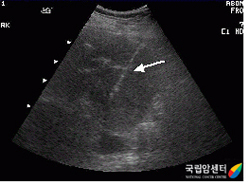 신종양에 대한 생검