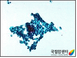 요세포 검사상의 악성세포 소견