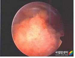 방광암의 방광내시경 사진