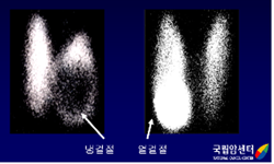 갑상선암의 갑상선 스캔