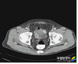 침윤성 방광암의 전산화단층촬영 사진