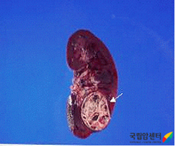근치적 좌신적출술 후의 육안사진