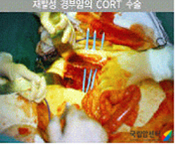 수술방사선동시요법(CORT)수술의예