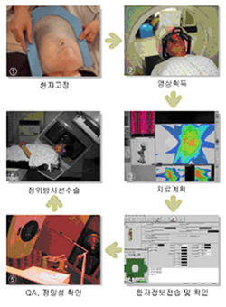 정위방사선수술과정