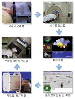 분할 정위 방사선 치료 과정