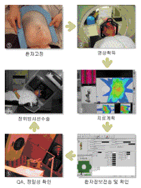 정위방사선수술과정