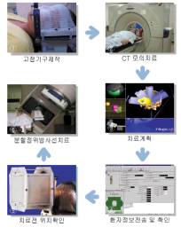 분할 정위 방사선 치료 과정