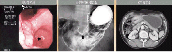 위암의 진단 방법