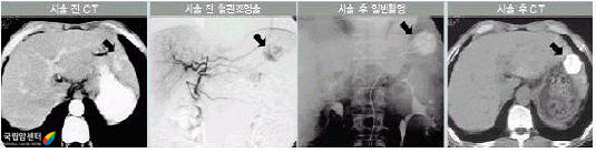 경동맥화학색전술 전후에 암발생 부위 비교