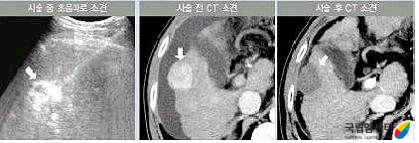 고주파열치료법 시술 전후의 암발생 부위 비교