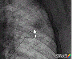 폐 전이 병소에 대한 미세침 흡인세포검사