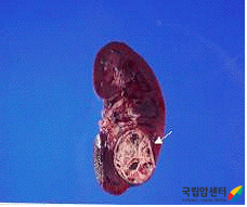 근치적 좌신적출술 후의 육안사진