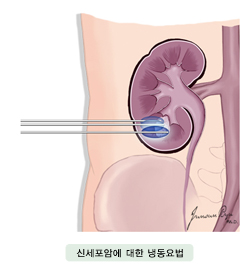 신세포암에 대한 냉동요법