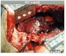 폐암 수술의 예