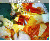 수술방사선동시요법(CORT)수술의예
