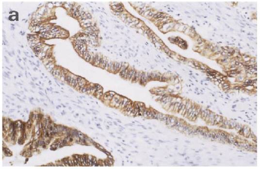 진단에 도움을 주는 면역조직화학검사의 예 (사이토케라틴(cytokeratin)염색) a