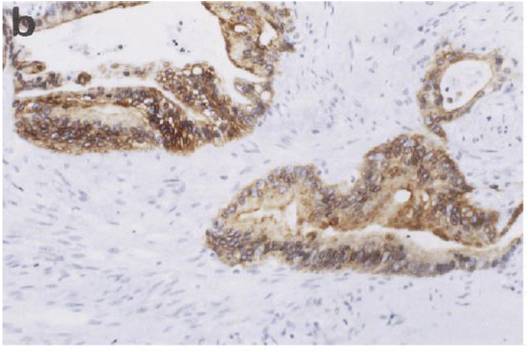 진단에 도움을 주는 면역조직화학검사의 예 (사이토케라틴(cytokeratin)염색) b