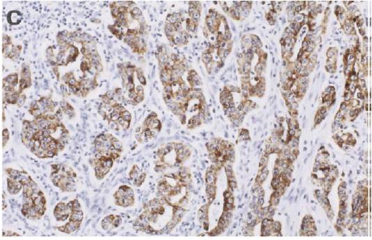 진단에 도움을 주는 면역조직화학검사의 예 (사이토케라틴(cytokeratin)염색) c