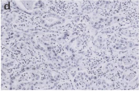 진단에 도움을 주는 면역조직화학검사의 예 (사이토케라틴(cytokeratin)염색) d