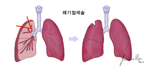 쐐기절제술