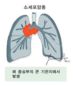 소세포암종