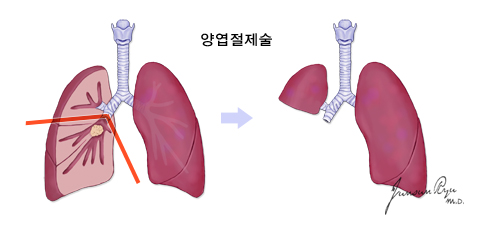 양엽절제술