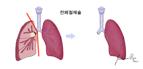 전폐절제술