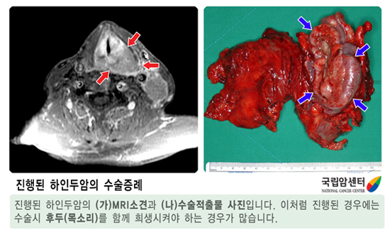 진행된 하인두암의 수술증례