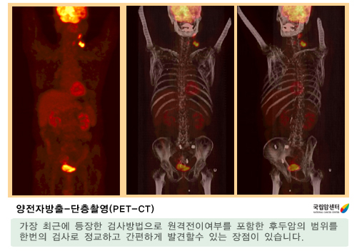 양전자방출-단층촬영(PET-CT)
