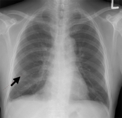 암의 전이로 의심되는 흉부  단순촬영(X-ray)