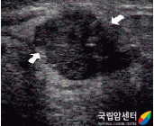 유방초음파술