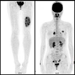 대퇴부에 발생한 포상연부육종(Alveolar soft part sarcoma) 환자의 PET소견
