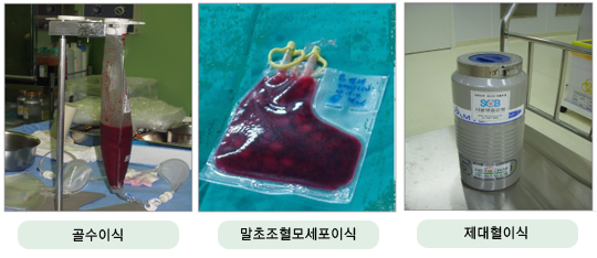 조혈모세포 공급원에 따른 이식의 종류