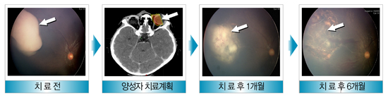 망막모세포종의 양성자 치료 사례