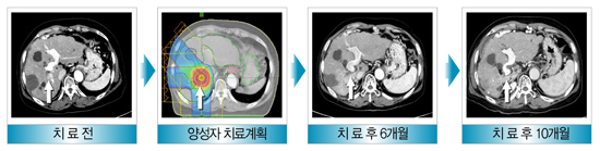 간세포암종의 양성자 치료 사례