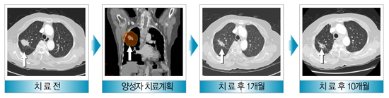 폐암의 양성자 치료 사례