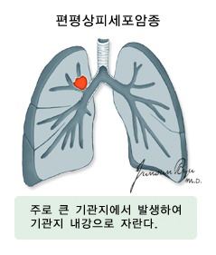 편평상피세포암종