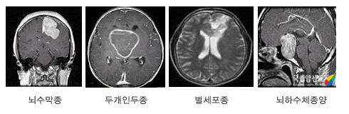 양성 소아뇌종양