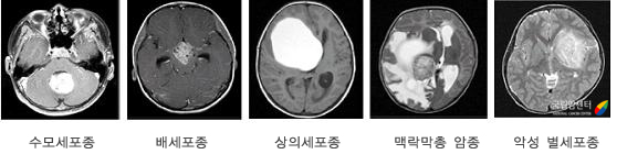 악성 소아뇌종양