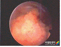 방광경 사진